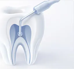 Root Canal Therapy